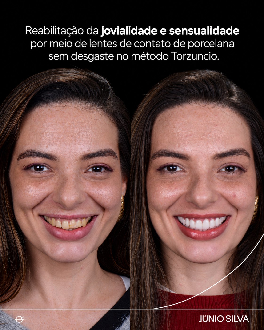 Caso clínico — reabilitação das sequelas do bruxismo com preservação estética, antes e depois