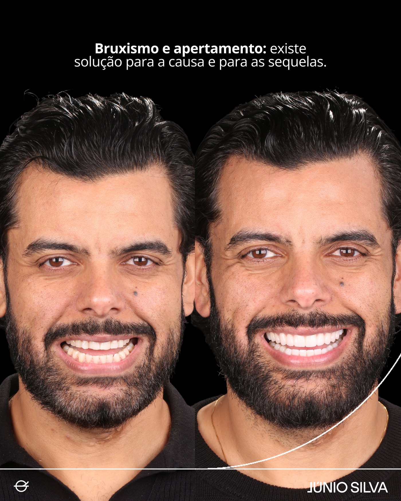 Caso clínico — reabilitação do bruxismo e da estética facial masculina, antes e depois