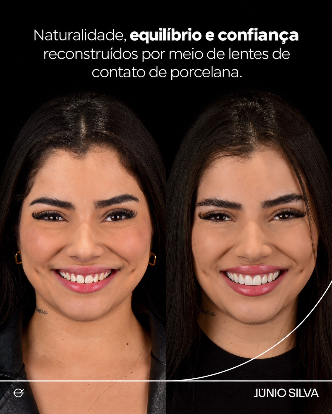 Caso clínico — facetas não invasivas e aumento da dimensão vertical, antes e depois