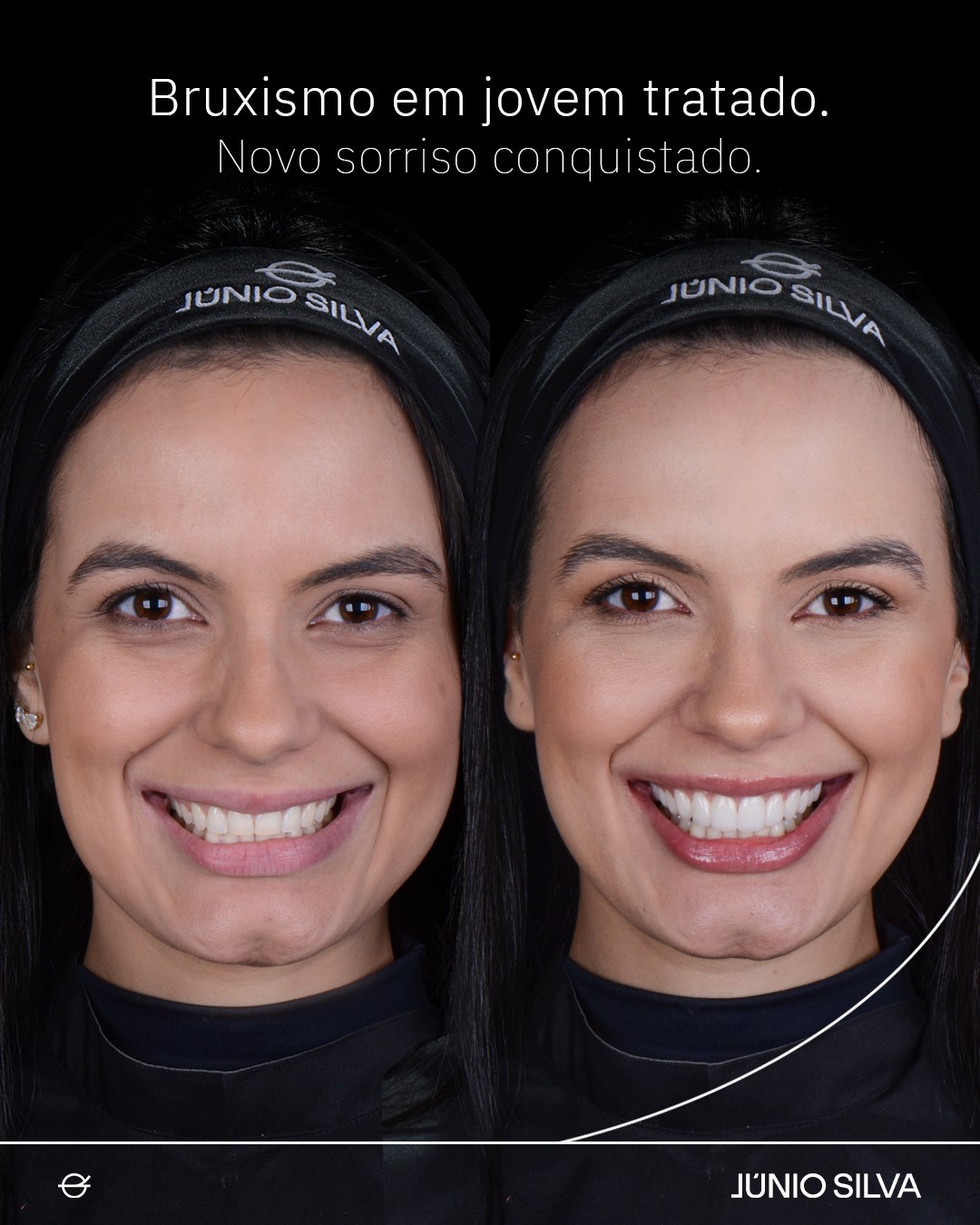Caso clínico — bruxismo em paciente jovem com desgaste anterior e dores de cabeça, antes e depois