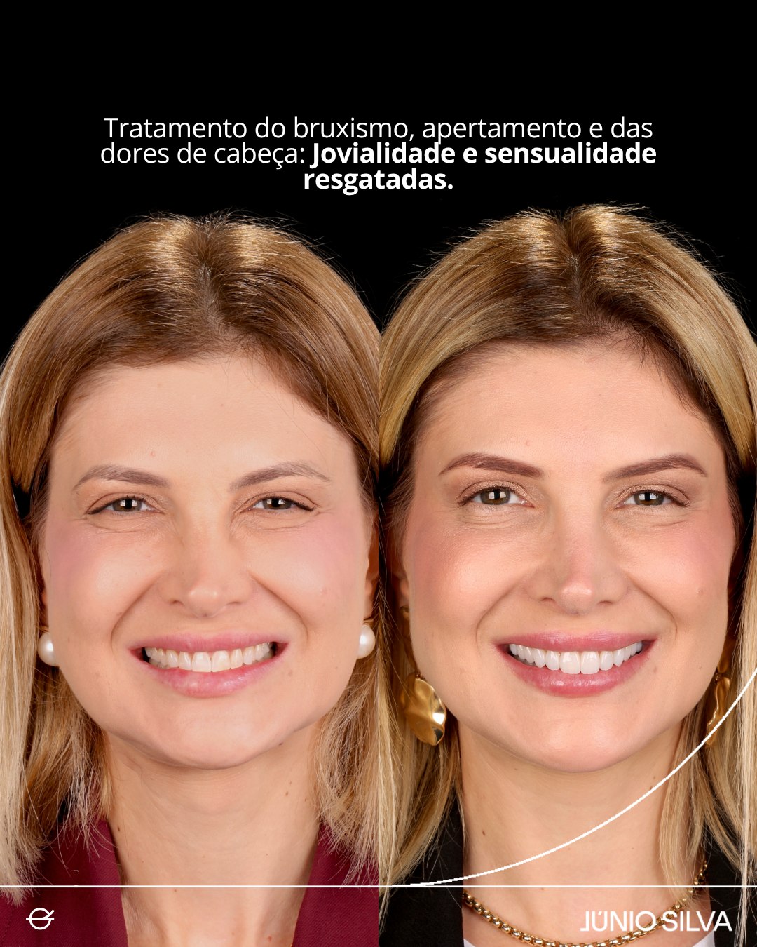 Caso clínico — bruxismo e apertamento severos com perda óssea e lesões cervicais, antes e depois